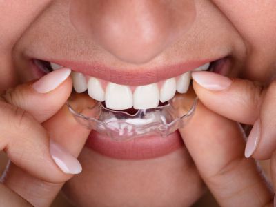 The Power of Clear Aligners