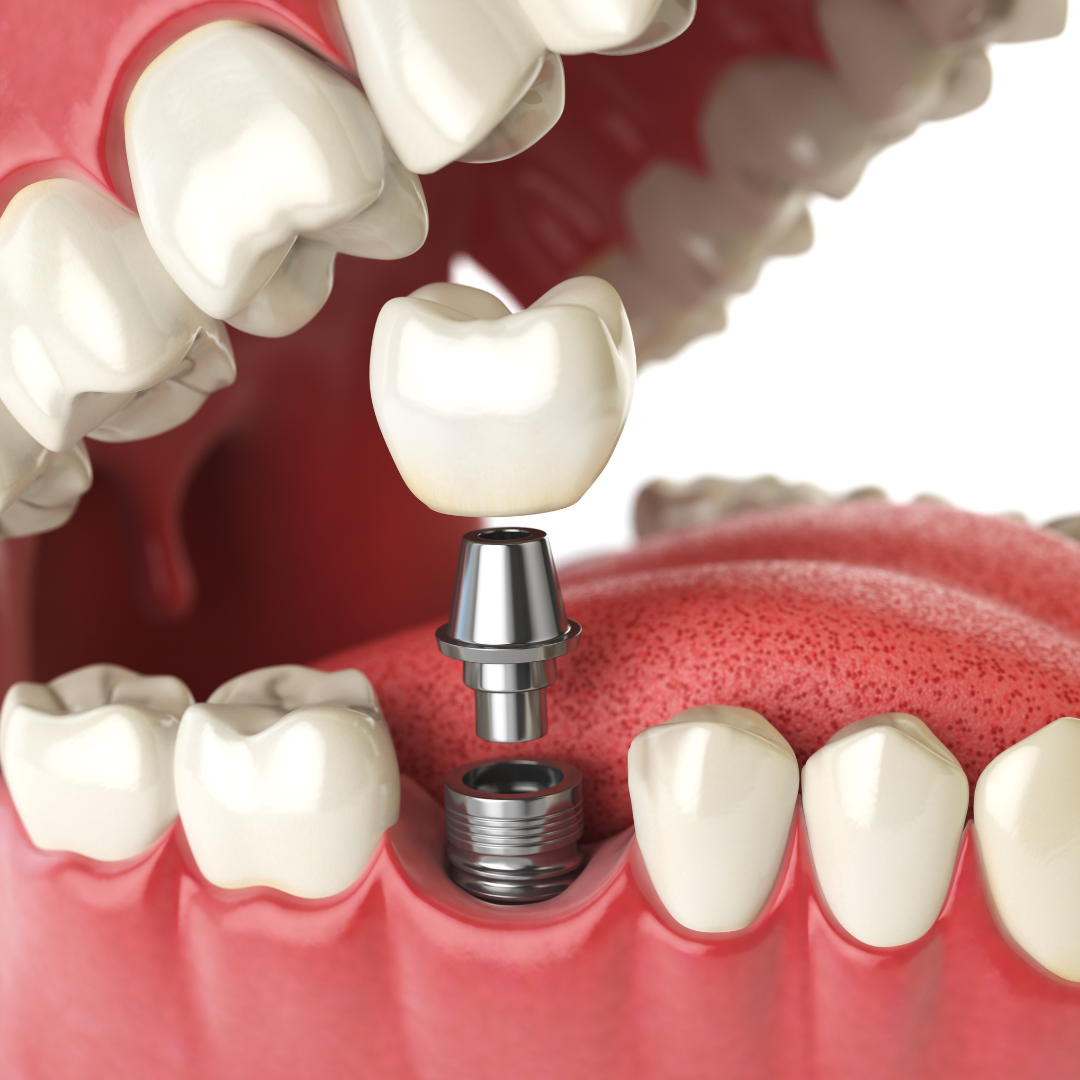 Advanced Crown Solutions: Tailored Excellence from Our CAD/CAM Dental Lab