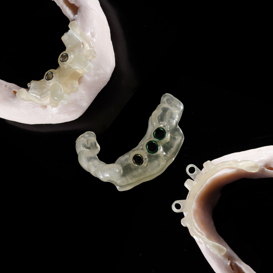 The Role and Importance of Surgical Guides in Modern Dentistry