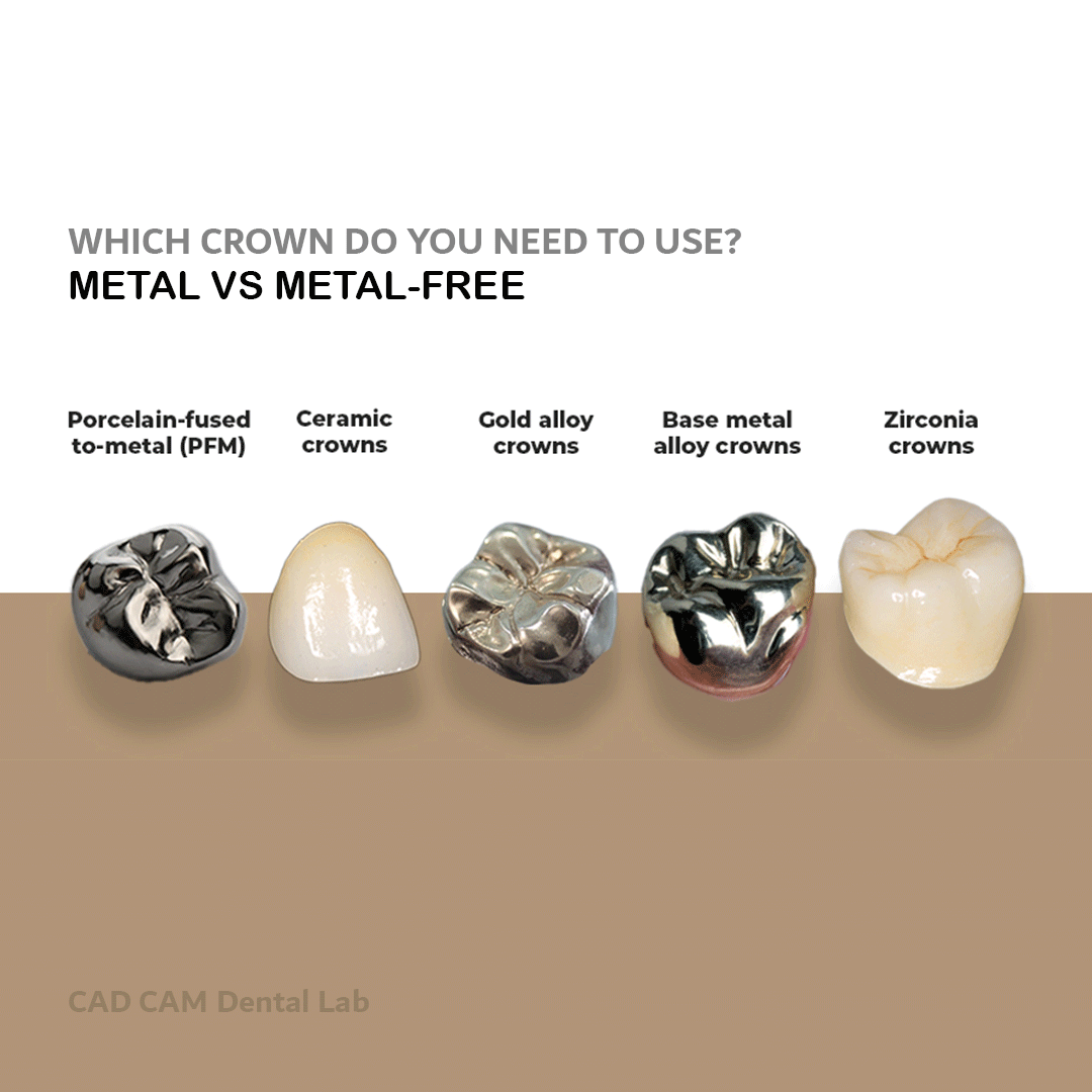 WHICH CROWN DO YOU NEED TO USE?  METAL VS METAL-FREE, WHICH IS THE BEST?