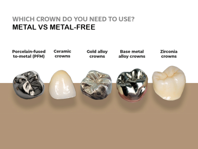 WHICH CROWN DO YOU NEED TO USE?  METAL VS METAL-FREE, WHICH IS THE BEST?