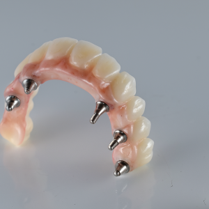 Screw-Retained Implant Bridge.