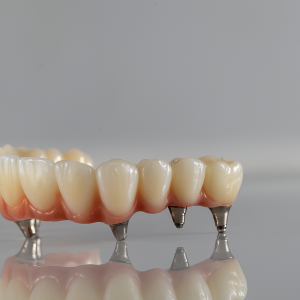 Screw-Retained Implant Bridge.